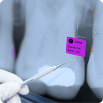 Pearl Second Opinion - Caries Detection